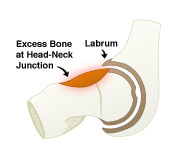 CAM impingement ,Saint Louis, Missouri