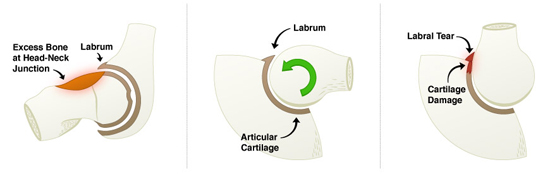 Hip Labral Tears, Saint Louis, Missouri