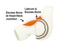Cam and Labral Debridement Animation, Saint Louis, Missouri