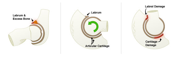 Pincer impingement injury patterns, Saint Louis, Missouri