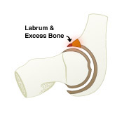 Pincer impingement, Saint Louis, Missouri